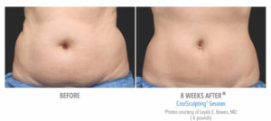 CoolSculpting Before and After tummy