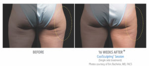 CoolSculpting Before and After Thighs