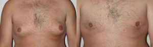 male breast before and after