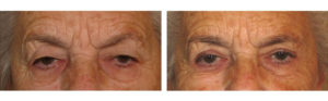 Eyelid Surgery before and after