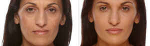 Injectable Filler before and after