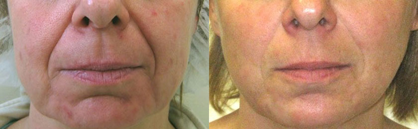 Thermage® before and after