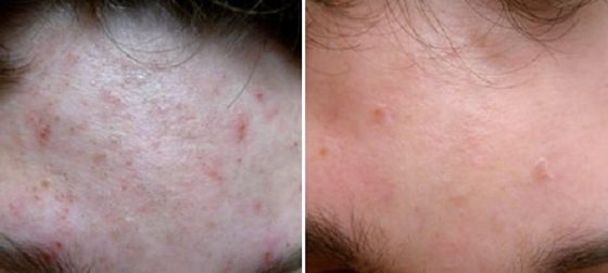 Clinical Peel before and after