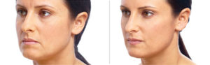 Injectable-Fillers before and after