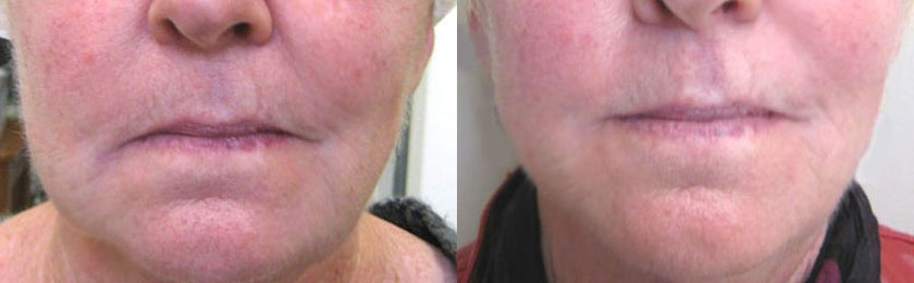 Thermage® before and after