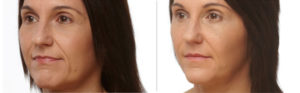 Injectable-Fillers before and after