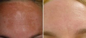 Clinical Peel before and after