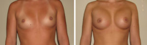 breast before and after