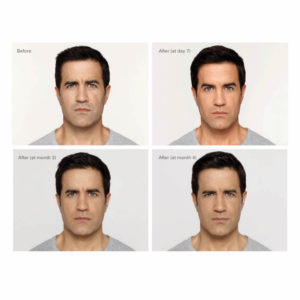 Oakville Plastic Surgery, male botox before and after