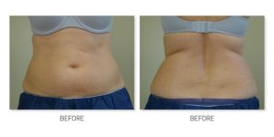 Oakville Plastic Surgery, CoolSculpting before and after