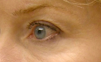After-Botox Treatment For Crow's Feet