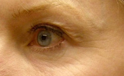 Before-Botox Treatment For Crow's Feet