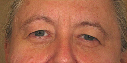 Before-Eyelid Surgery