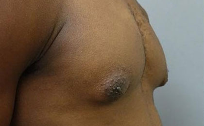 Before-Male Breast Reduction