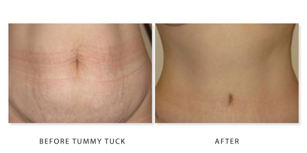 Oakville Plastic Surgery Tummy Tuck Before And After04 Oakville Plastic Surgery Dr Nancy 9659