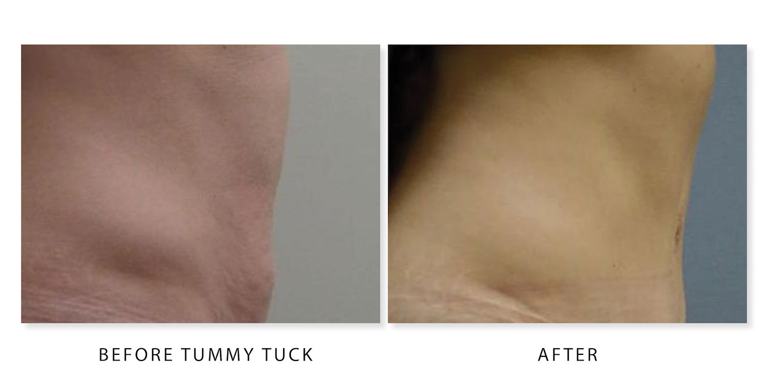 Oakville Plastic Surgery, tummy tuck before and after