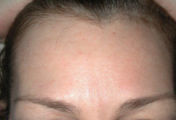 After-Botox Treatment