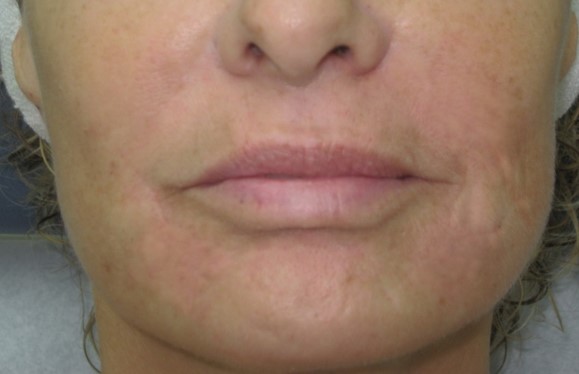 After-Injectable Fillers