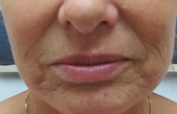 Before-Injectable Fillers