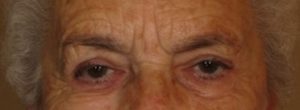 Eyelid Surgery Post