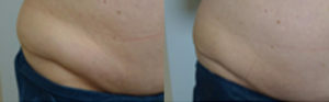 Coolsculpting Before/After 2