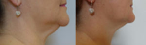 Coolsculpting Before/After 3