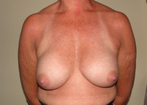 Breast Implant Pre