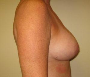 Breast Implant Post