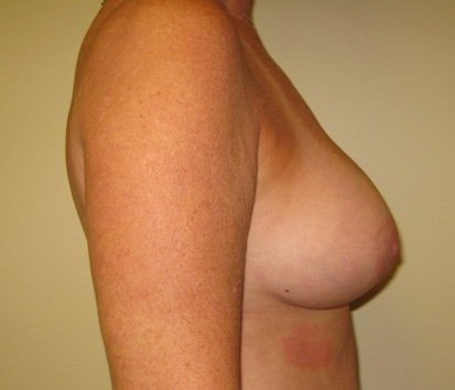 After-Breast Implant Revision