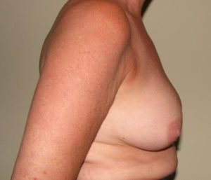 Breast Implant Pre