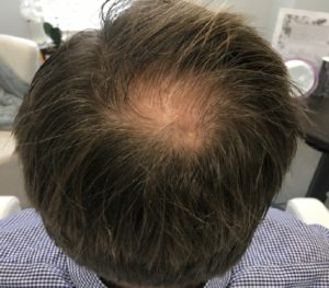 Hair Restoration After