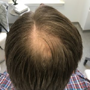 Hair Restoration After