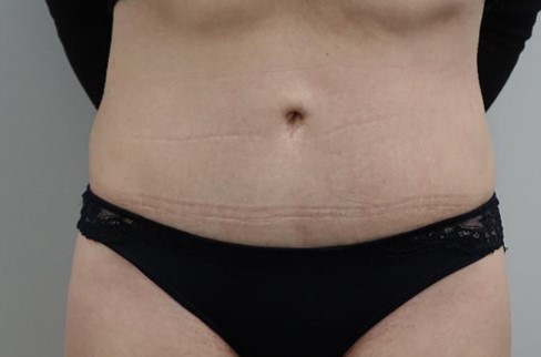 After-Tummy Tuck