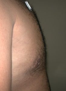Gynecomastia After Sideview