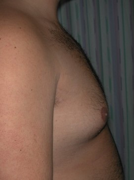 Before-Male Breast Reduction