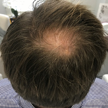 After-Hair Restoration