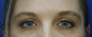 Eyelid Surgery Post
