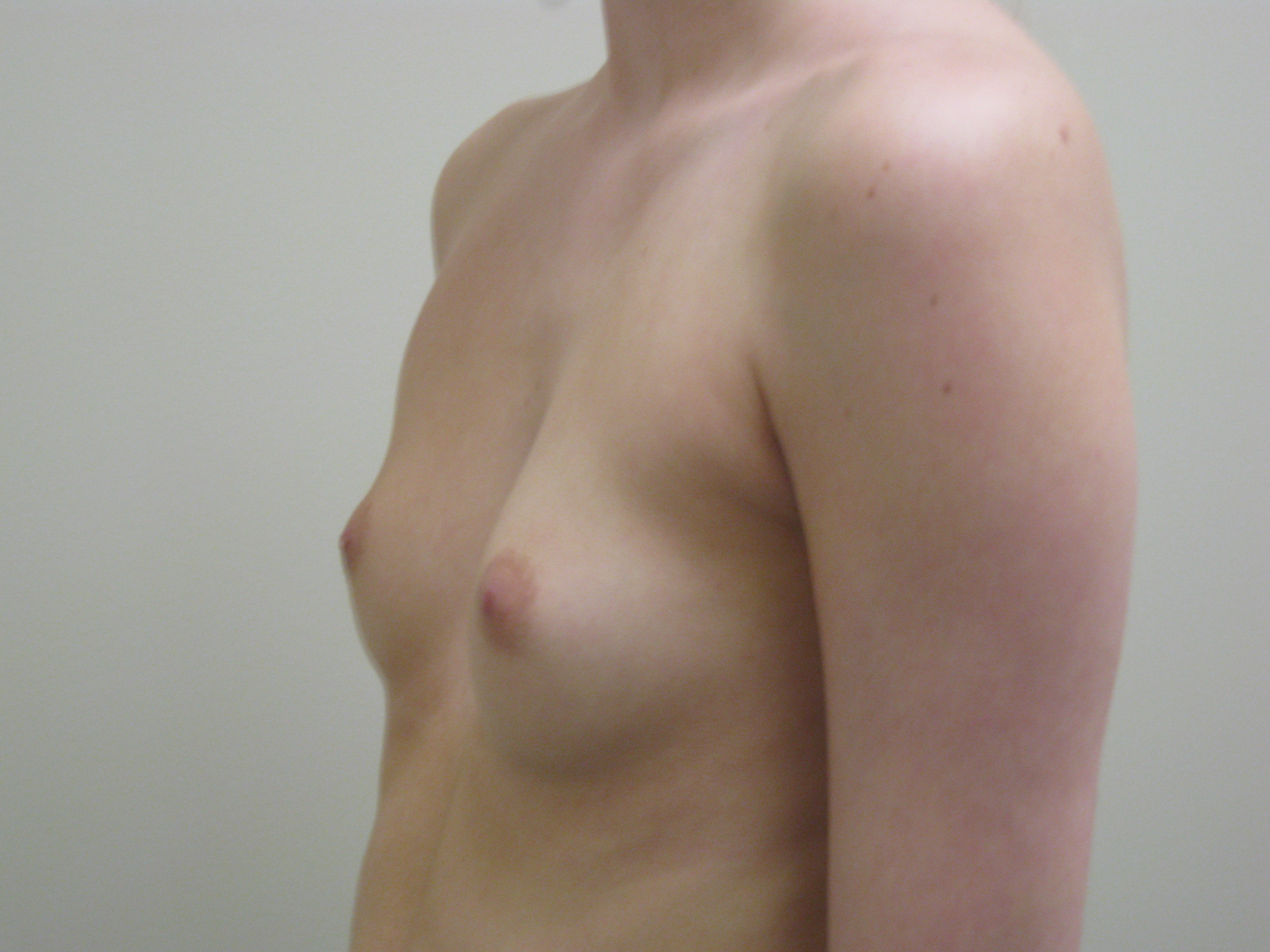 Before-Breast Implant