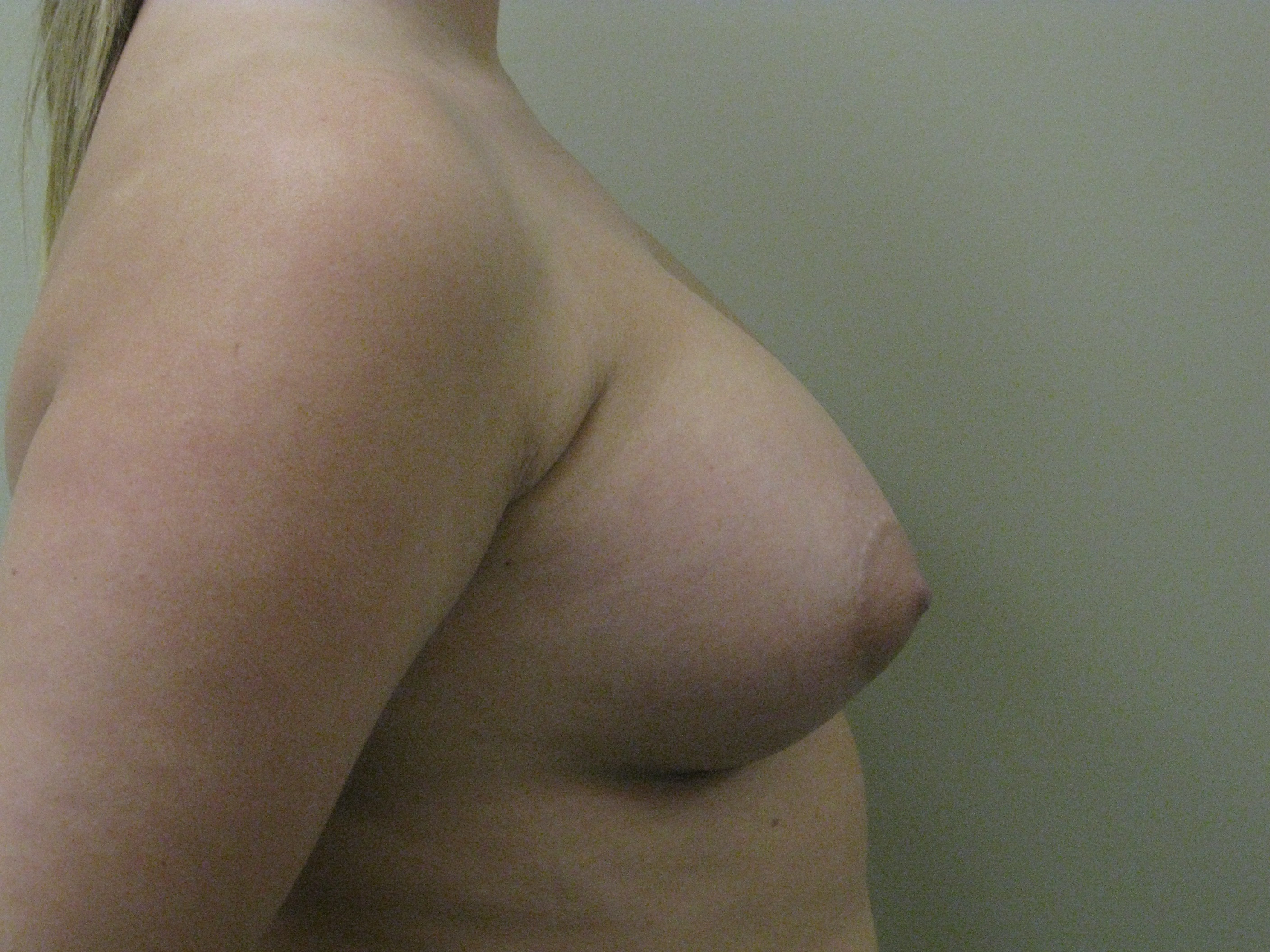 After-Breast Implants
