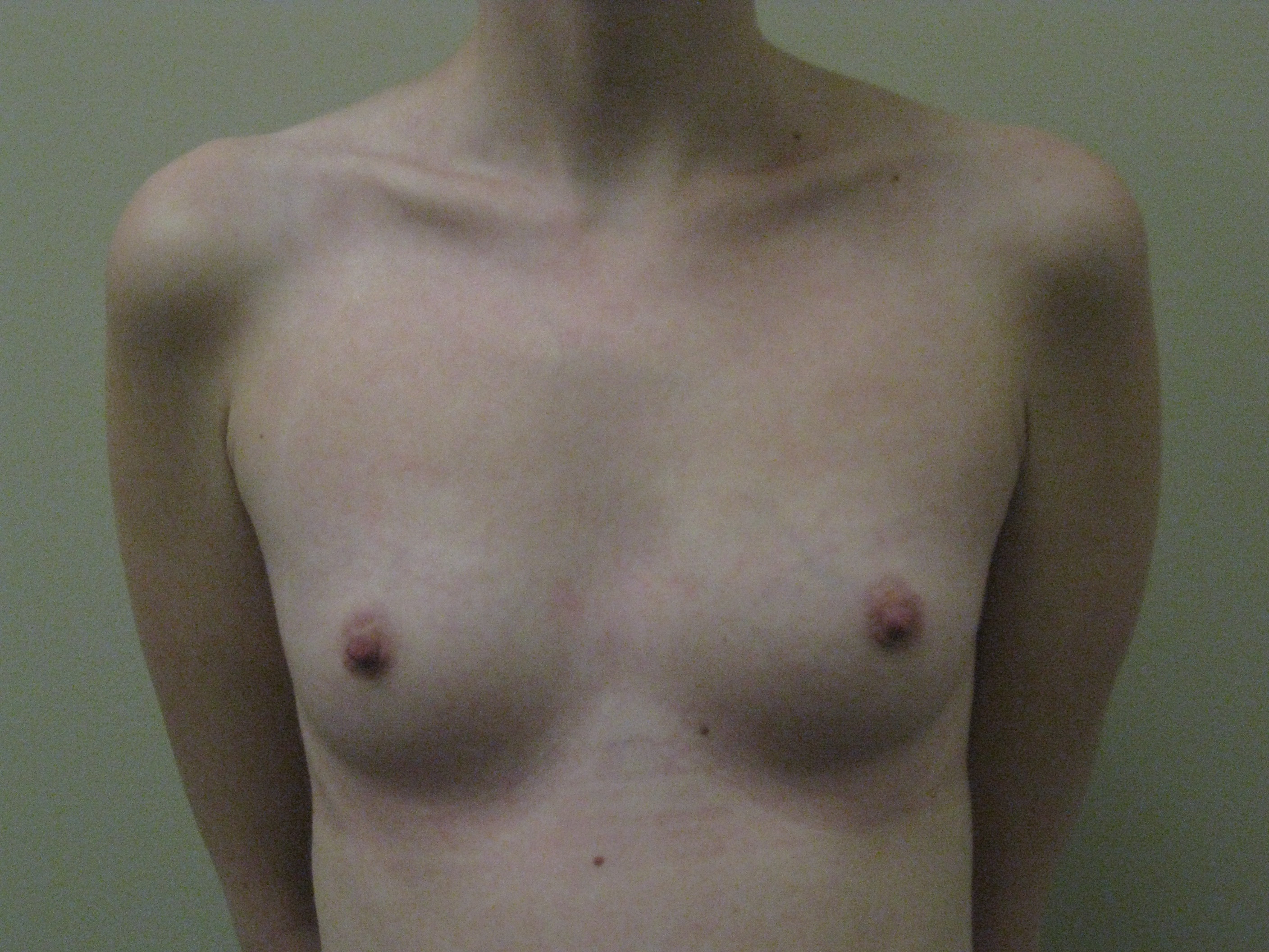 Before-Breast Implant