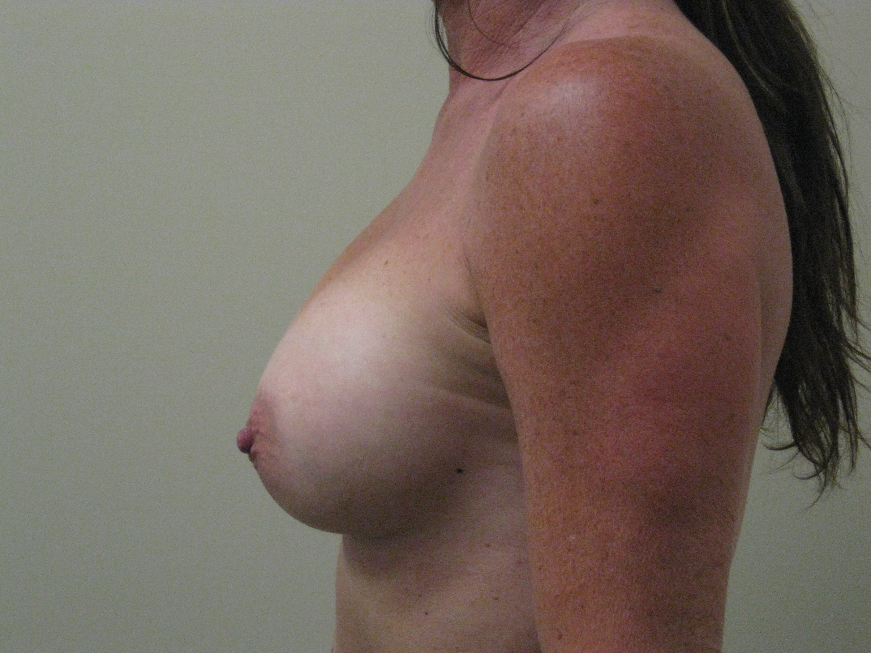 After-Breast Implants