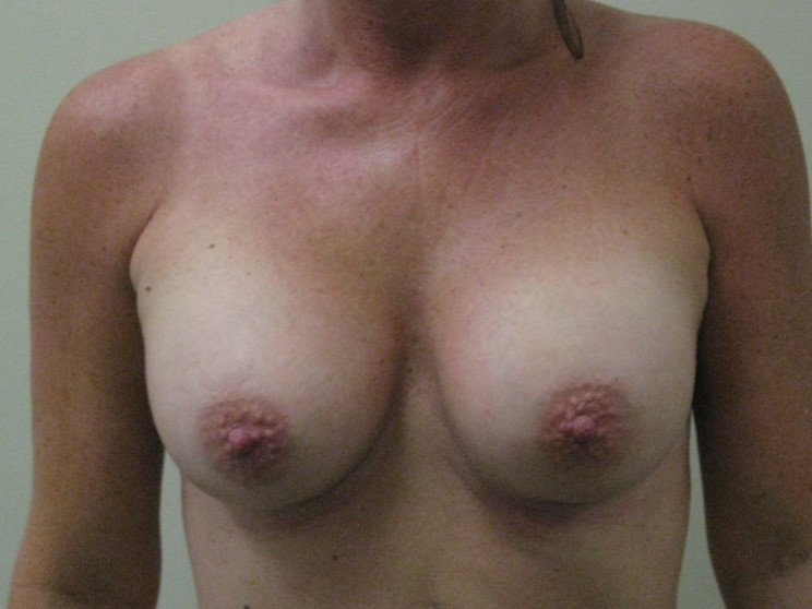After-Breast Implant