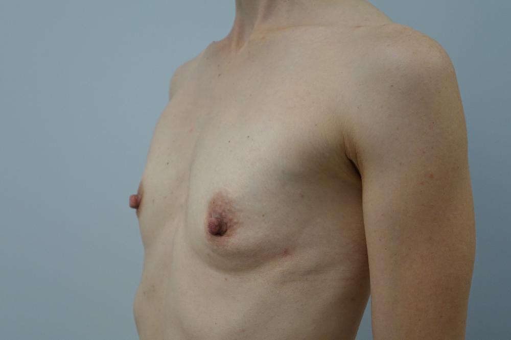 Before-Breasts Implant