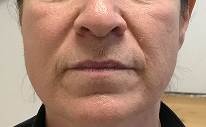 Before-Injectable Filler