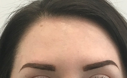 After-Forehead Lines