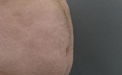 Before-Male Liposuction