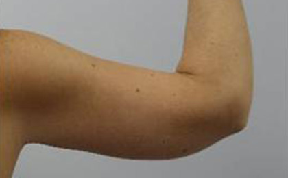 After-Arm Lift
