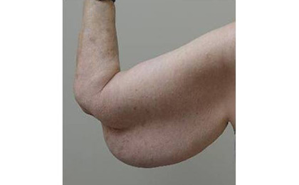 Before-Arm Lift