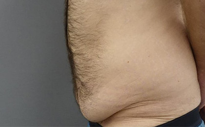 Before-Male Tummy Tuck
