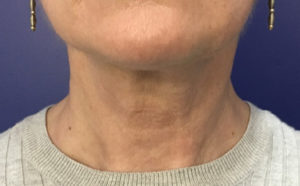 Neck After